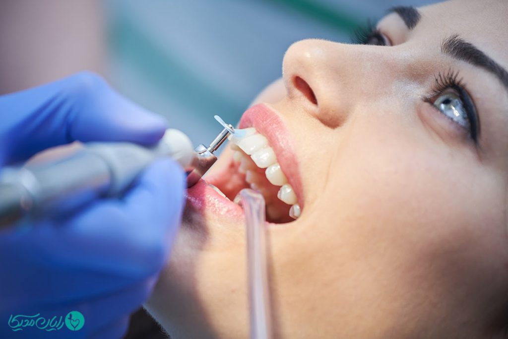 سریع‌ترین روش جرم‌گیری دندان در خانه