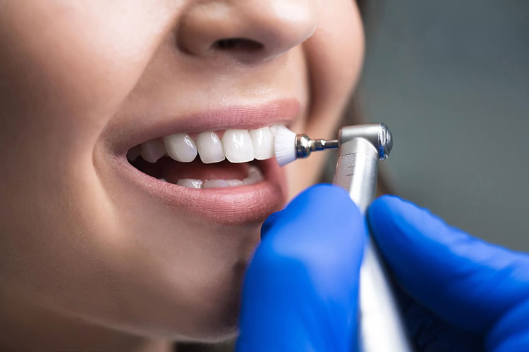 سریع‌ترین روش جرم‌گیری دندان